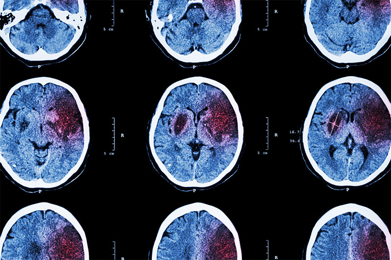 CT scan of brain showing ischemic stroke 