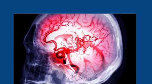 Inspiratory muscle training improves diaphragmatic thickness, respiratory function, exercise capacity and quality of life in people after stroke